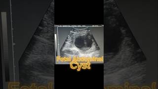 Anomaly Scan  Anomaly Ultrasound  Fetal Cyst  Oligohydramnios on Ultrasound [upl. by Amoihc]