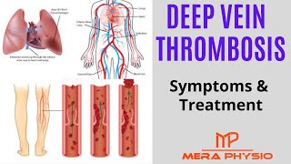 Deep Vein Thrombosis DVT  Causes Symptoms Treatment Exercises  In Hindi  Mera Physio [upl. by Nnaeilsel445]