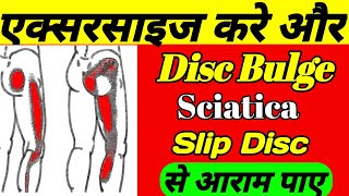 कमर से पैरों में खिंचाव सुन्नपनझनझनाहट और दर्द का सबसे आसान इलाजSlip Disc Bulging Treatment [upl. by Neladgam253]