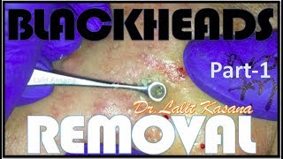 BIG BLACKHEAD REMOVALANTIACNE TREATMENT PART1 [upl. by Ahsoyem]