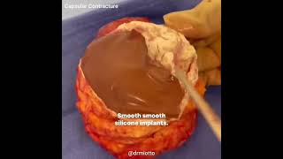 Capsular Contracture after a total Capsulectomy with breast implant removal [upl. by Oberheim]