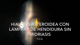 Hialosis asteroidea con lámpara de hendidura sin midriasis [upl. by Osterhus]