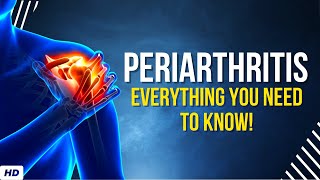 Periarthritis Everything You Need to Know [upl. by Bollinger313]