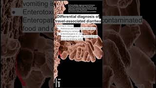 Differential diagnosis of travelassociated diarrhea [upl. by Lil]