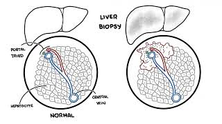 Autoimmune Hepatitis [upl. by Melena504]