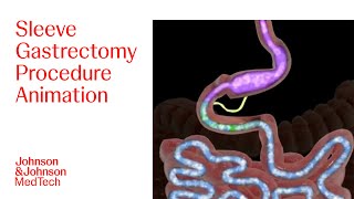 Sleeve Gastrectomy Procedure Animation  JampJ MedTech [upl. by Jaco]