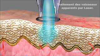 Traitement couperose par laser vasculaire  dermolaser toulouse [upl. by Lamori961]