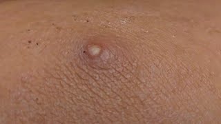 Drainage of an infected cyst on the leg [upl. by Dambro]