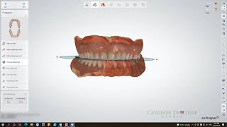 Reference Denture Design [upl. by Milon323]