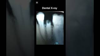 Dental Xray [upl. by Gereron]