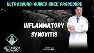 UltrasoundGuided Procedure in Knee Inflammatory Synovitis [upl. by Lebatsirc]