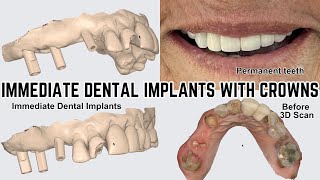 Dental implant front teeth  Upper jaw Full Arch Immediate Dental Implants  Before and After [upl. by Eilzel240]