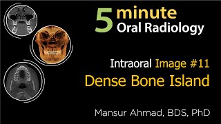 Dense Bone Island Intraoral Radiographic Interpretation [upl. by Esyle]