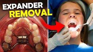 Getting Palatal Expander OFF… What happens when you get your Expander Off  McKinney Orthodontist [upl. by Recnal]