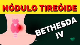 Nódulo de tireóide Bethesda IV é câncer Tem que operar [upl. by Netsuj940]