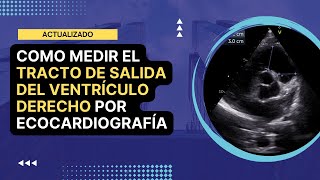 🏅Cómo medir el TRACTO DE SALIDA DEL VENTRÍCULO DERECHO TSVD por ecocardiografía Actualizado [upl. by Ahselyt]