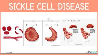 Sickle cell Disease Simplified [upl. by Perce]