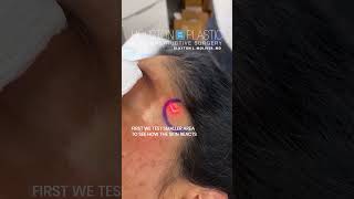 Laser treatment for hyperpigmentation oddlysatisfying hyperpigmentation [upl. by Analiese60]