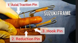 Suzuki Frame Surgery  Finger PIP joint fracture subluxation  Dr Prateek Joshi [upl. by Larochelle]