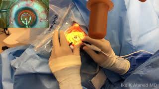 Dr Ike Ahmed ZEPTO® Precision Cataract Surgery Capsulotomy System Video 2 of 2 [upl. by Shoifet]