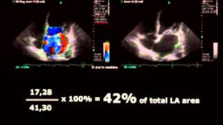 Volodymyr Pavliuk MD PhD Echocardiographic Assesment of Mitral Regurgitation [upl. by Clywd]