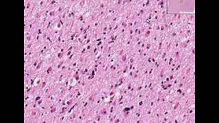 Histopathology BrainAstrocytoma [upl. by Kenta]