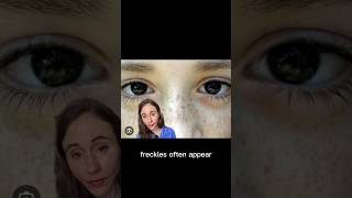 Freckles vs Age Spots dermatologist DrDrayzday [upl. by Sheffield]