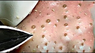 Best Satisfying Nose Plucking Blackheads Whiteheads Removal  Acne Treatment 19 [upl. by Air]