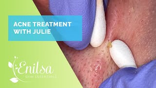 Acne Treatment amp Extractions on Julie  New Patient [upl. by Ardena]