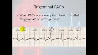 Basic Electrophysiology part 7  Atrial Rhythms part 1 Introduction and PACs [upl. by Gnuoy]