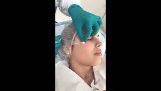 OZONOTERAPIA FACIAL PARA LA ROSACEA PARTE 2 [upl. by Orest]