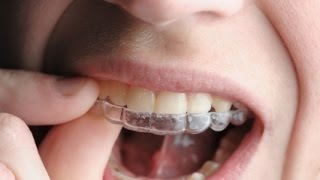 Pulire lapparecchio per i denti i consigli dell odontoiatra [upl. by Seiter661]