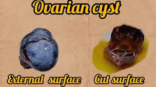 Ovarian cyst  grossing the tissue in histopathology  complex ovarian cyst  cyst histopathology [upl. by Artair]