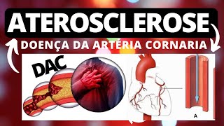 ATEROSCLEROSE CORONARIANA Definição fisiopatologia manifestações clínicas fatores de riscos [upl. by Lindon]