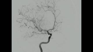 Arteriografia Cerebral Normal [upl. by Reitman]