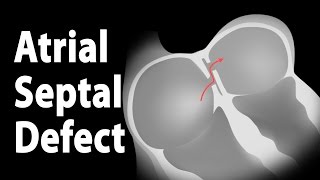 Atrial Septal Defect ASD Animation [upl. by Amend]