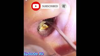 ASMR earwax removal Flexible earwax Have you ever seen this type of earwax [upl. by Eilerua]