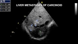 Carcinoid Disease Echocardiography [upl. by Lahtnero]