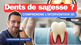 Comprendre l’Extraction DENTS DE SAGESSE [upl. by Malissa383]