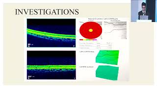 AIOC2024 GP199 topic Dr Markandeya Singh Foveal Aplasia [upl. by Adiesirb658]