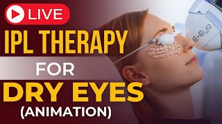 IPL Therapy for Dry Eye Relief I StepbyStep Procedure [upl. by Tnomyar]