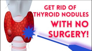 Treat Thyroid Swelling Without Surgery  Ablation and Embolization [upl. by Beauvais]