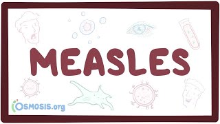 Measles  causes symptoms diagnosis treatment pathology [upl. by Cecile]