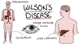 Understanding Wilsons Disease [upl. by Iadahs]