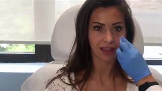 Restylane Lyft Filler with our Nurse Practitioner Susie  Transformations Plastic Surgery amp Medspa [upl. by Bronez308]