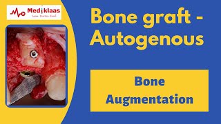 Autogenous Bone Grafts [upl. by Apthorp]