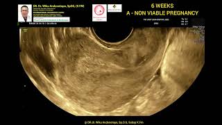 6 weeks A NoN Viable pregnancy [upl. by Belshin]