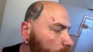 Day 1 Of Superficial Basal Cell Carcinoma Skin Cancer Treatment With Aldara Cream [upl. by Garling]