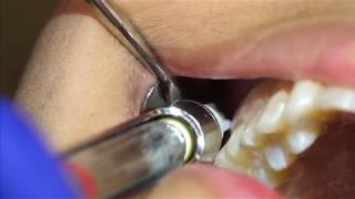 Posterior Superior Alveolar PSA Injection Demonstration and Overview 4K [upl. by Atikram]