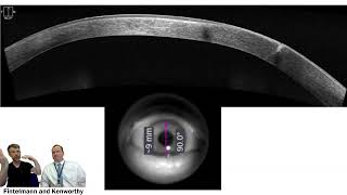 Revision of Gaping Astigmatic Keratotomy [upl. by Harahs]